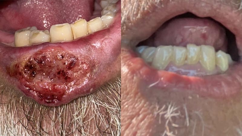 AI and diagnostic safety: Anchoring bias in a case of lip melanoma