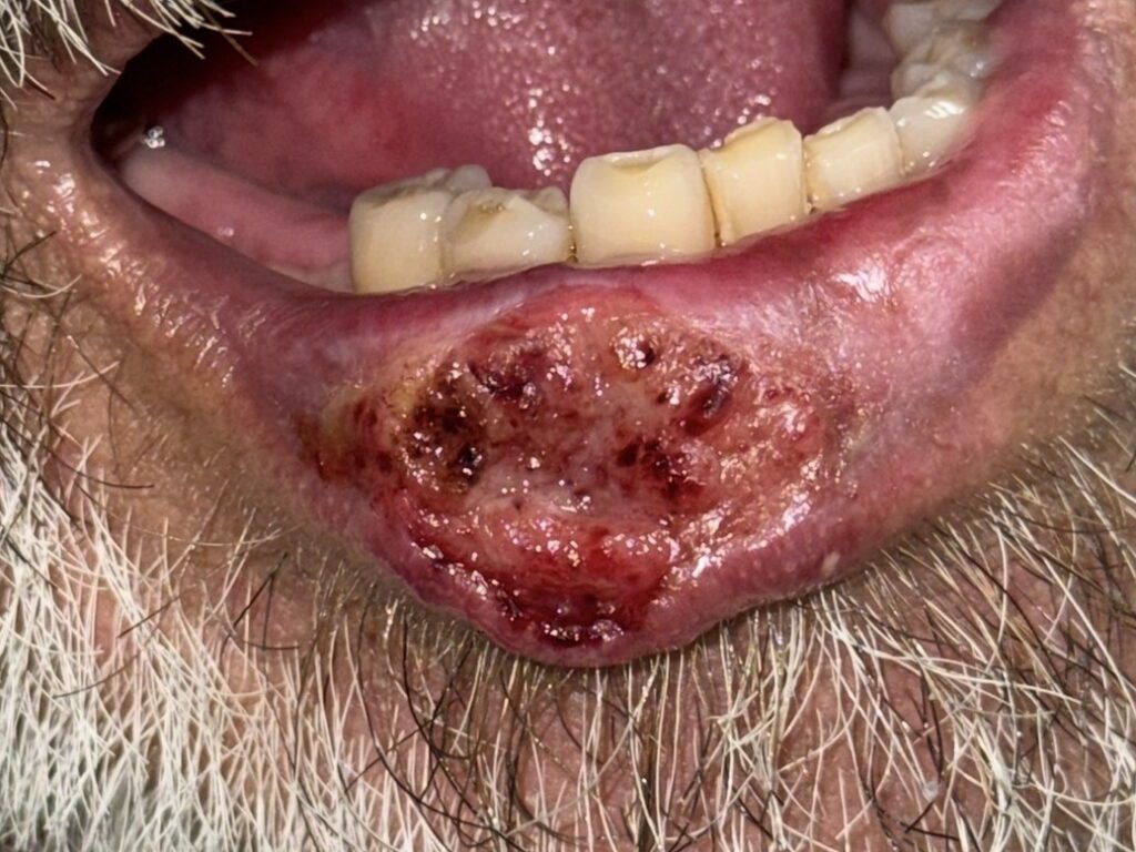 Lip melanoma pre-treatment