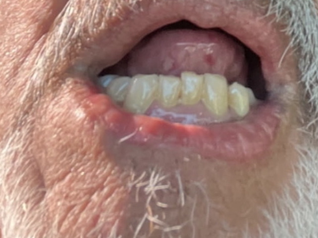 Post-treatment