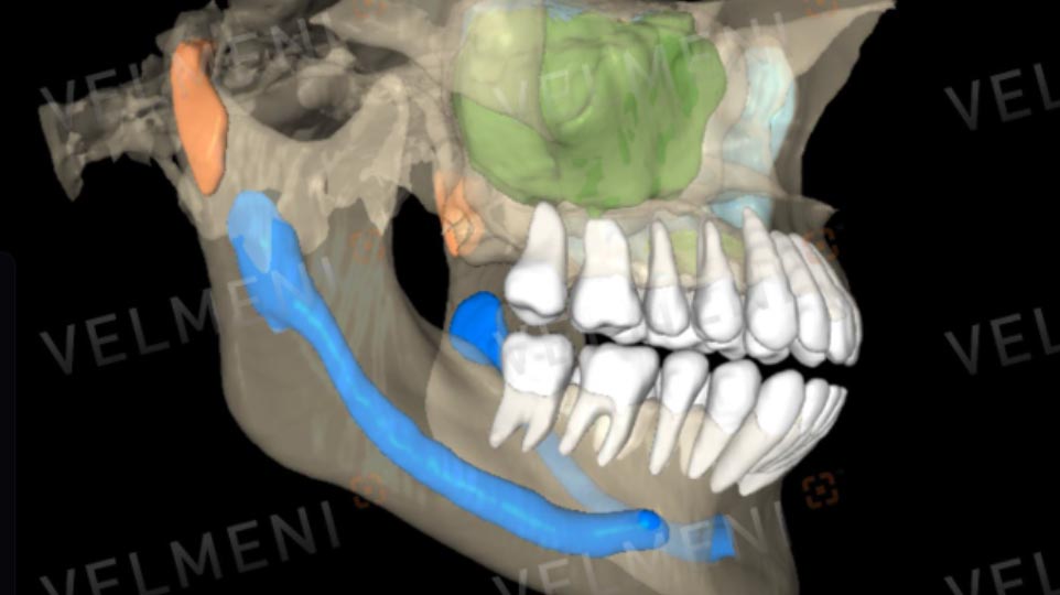 Dental AI in action: Solving clinical challenges one scan at a time using VELMENI